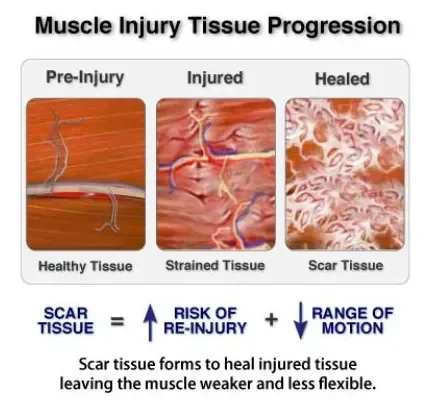 A diagram showing the progression of a muscle injury on muscle tissue